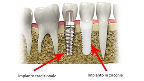  Ossido di Zirconio: Materiale Biocompatibile per Impianti Dentali e Ortopedici!